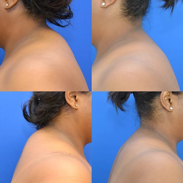 Exercício para eliminar calombo no pescoço